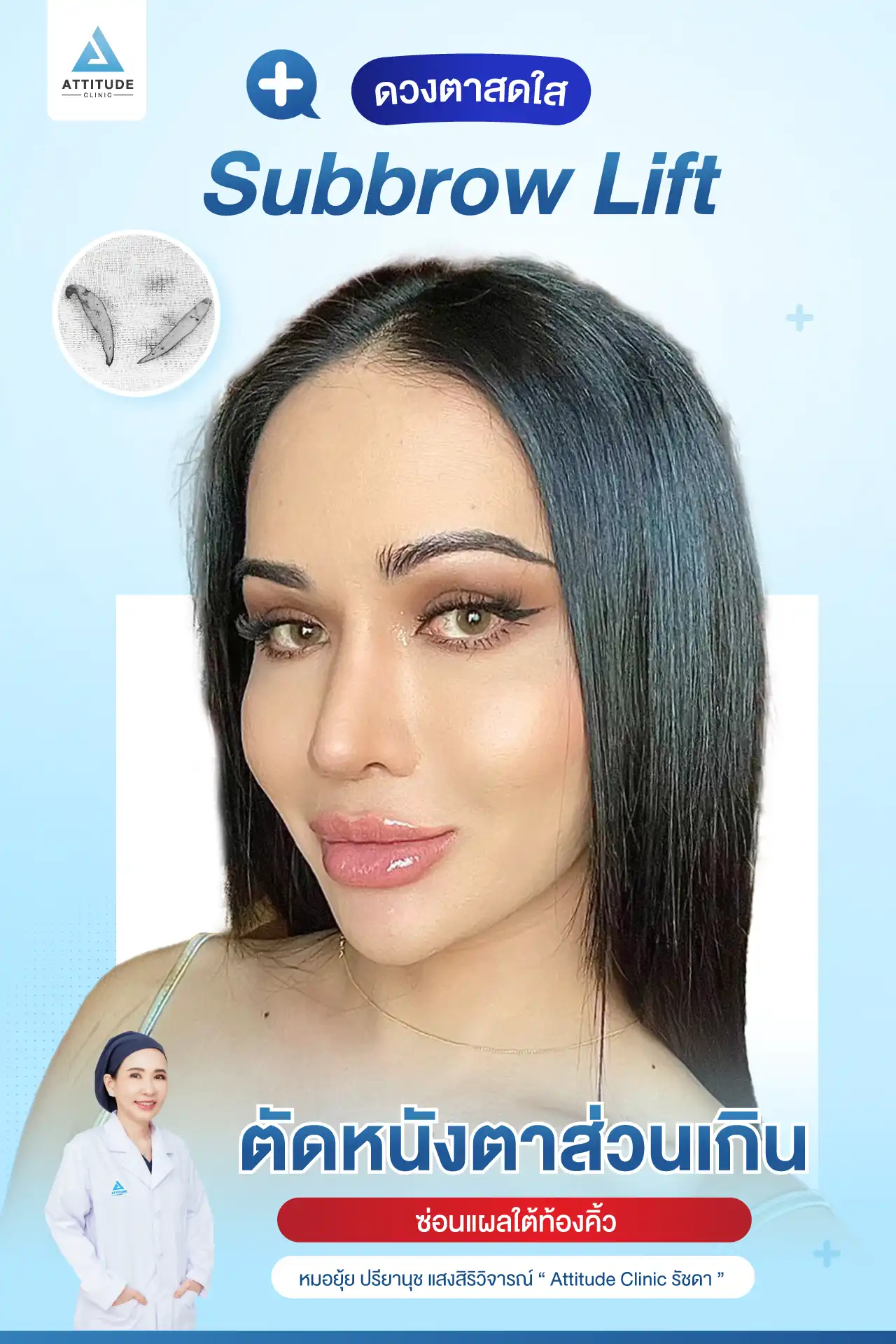 รีวิว Sub Brow Lift ผ่าตัดยกหนังตา เคสคุณเปา คืนความสดใสให้ดวงตา เก็บแผลใต้ทิ้งคิ้ว เนียนกริบ สวยเป๊ะ โดยหมอยุ้ย Attitude Clinic รัชดา