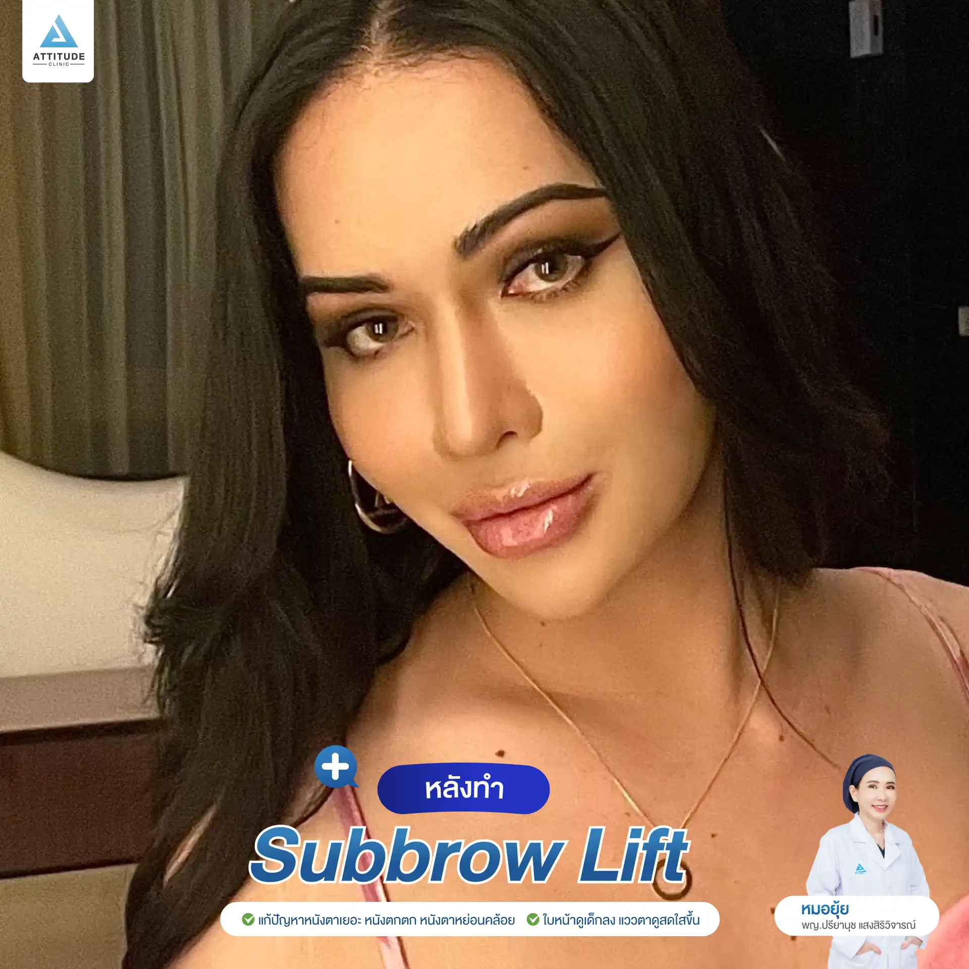 รีวิว Sub Brow Lift ผ่าตัดยกหนังตา เคสคุณเปา คืนความสดใสให้ดวงตา เก็บแผลใต้ทิ้งคิ้ว เนียนกริบ สวยเป๊ะ โดยหมอยุ้ย Attitude Clinic รัชดา
