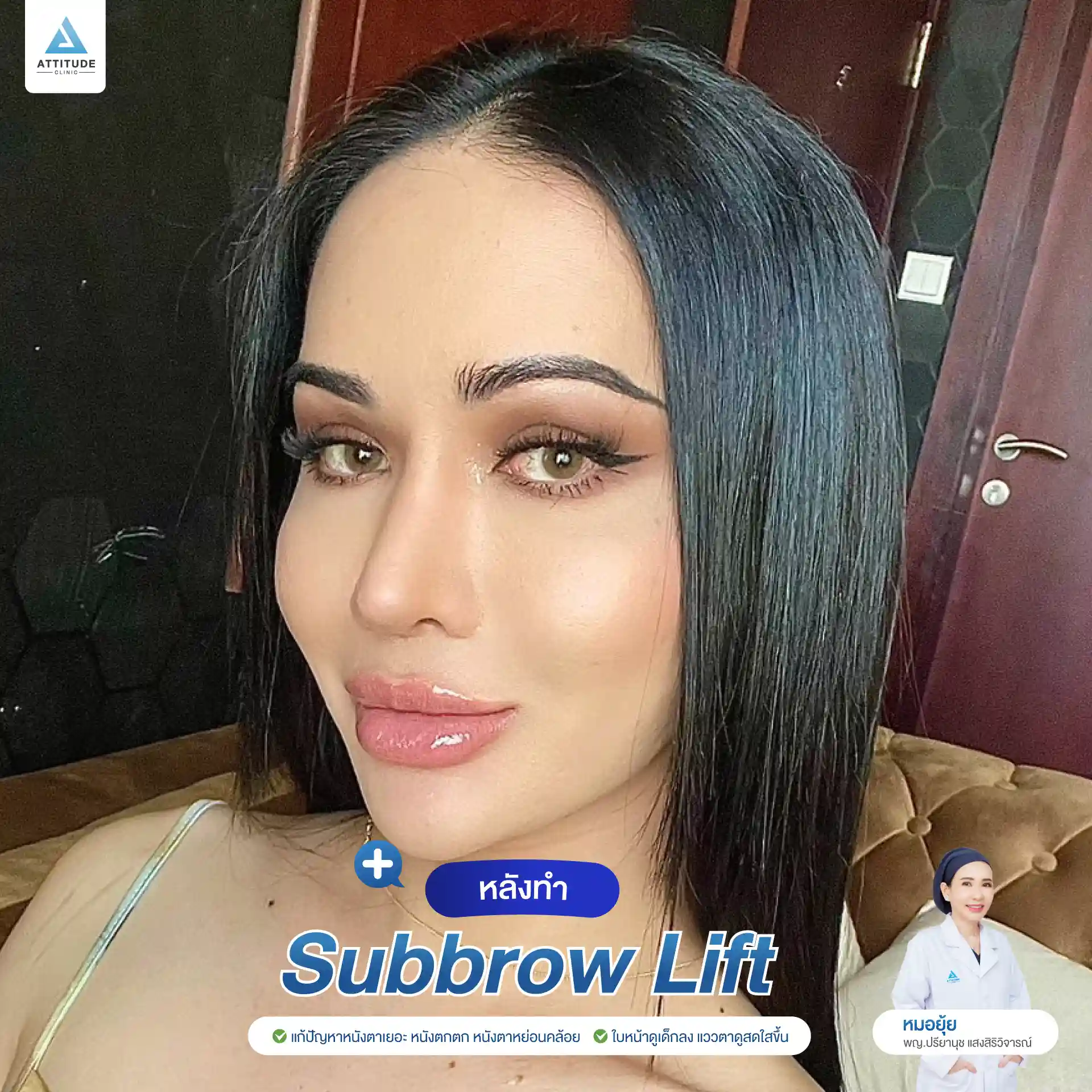 รีวิว Sub Brow Lift ผ่าตัดยกหนังตา เคสคุณเปา คืนความสดใสให้ดวงตา เก็บแผลใต้ทิ้งคิ้ว เนียนกริบ สวยเป๊ะ โดยหมอยุ้ย Attitude Clinic รัชดา