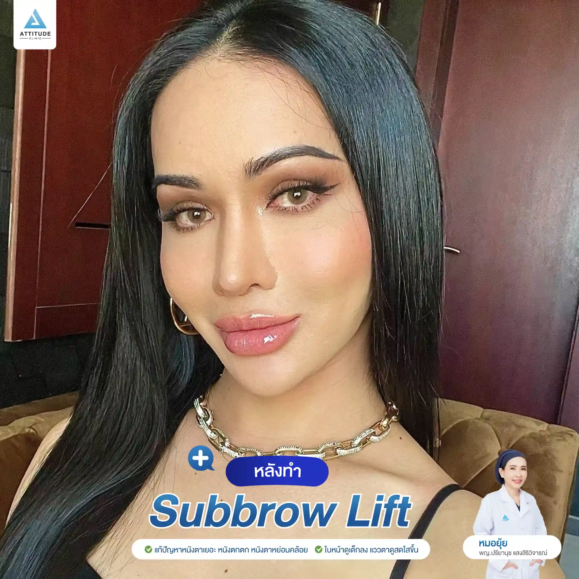 รีวิว Sub Brow Lift ผ่าตัดยกหนังตา เคสคุณเปา คืนความสดใสให้ดวงตา เก็บแผลใต้ทิ้งคิ้ว เนียนกริบ สวยเป๊ะ โดยหมอยุ้ย Attitude Clinic รัชดา