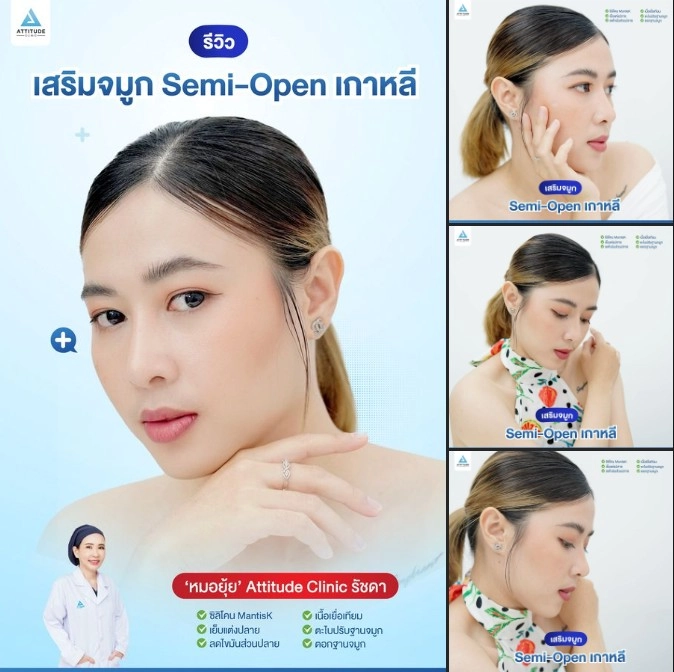 เสริมจมูก