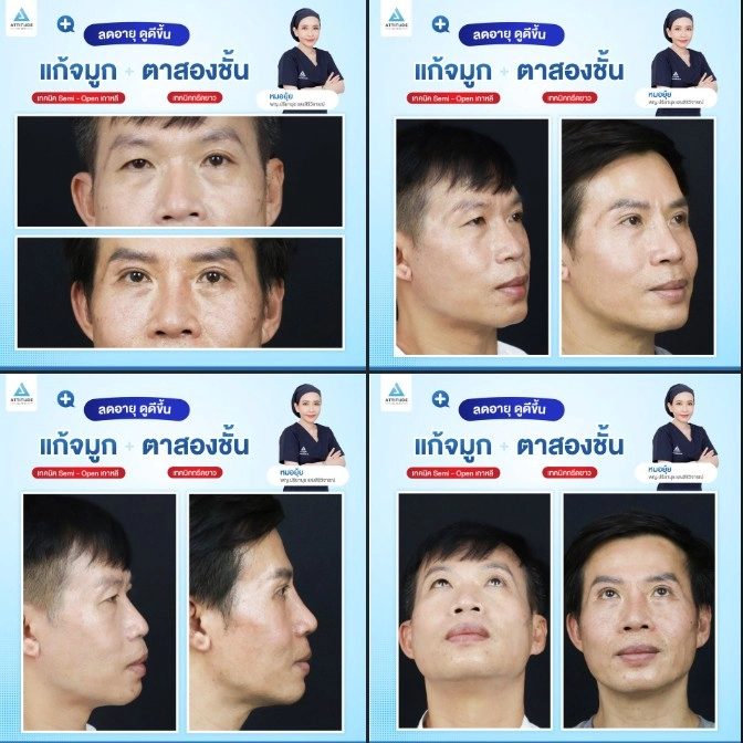 ทำตาสองช้้น เสริมจมูก