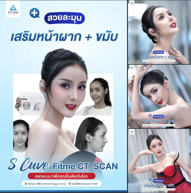 เสริมหน้าผาก เสริมขมับ