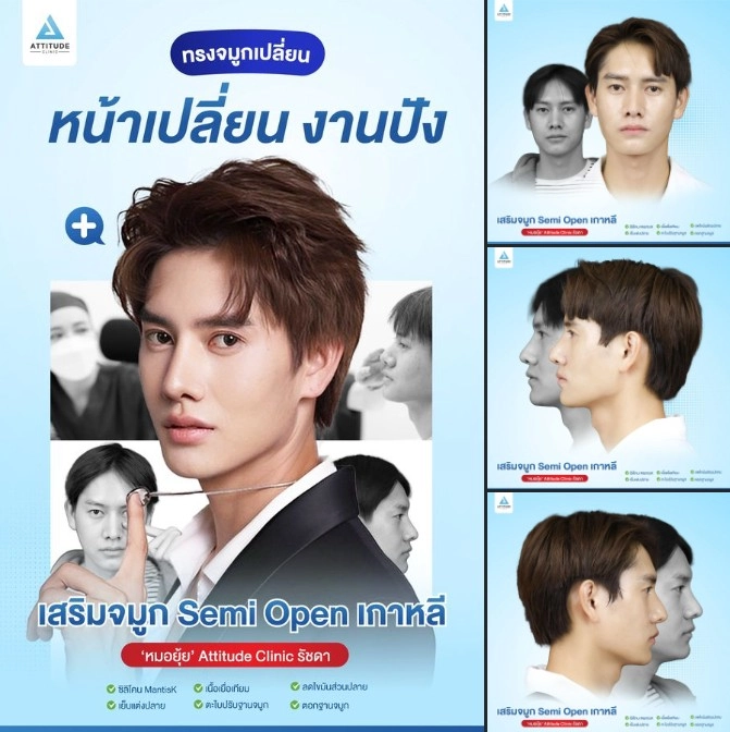 เสริมจมูก