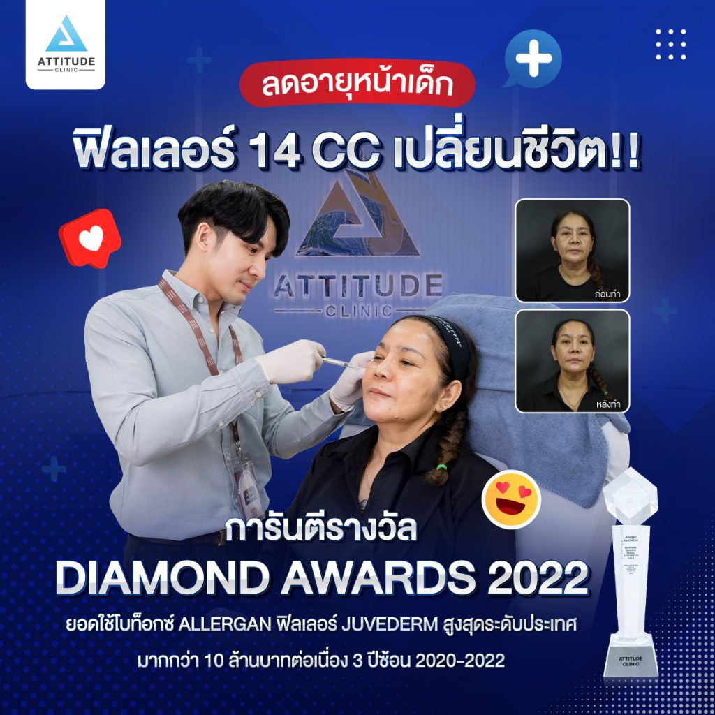 รีวิวฉีดฟิลเลอร์ juvederm 14 cc