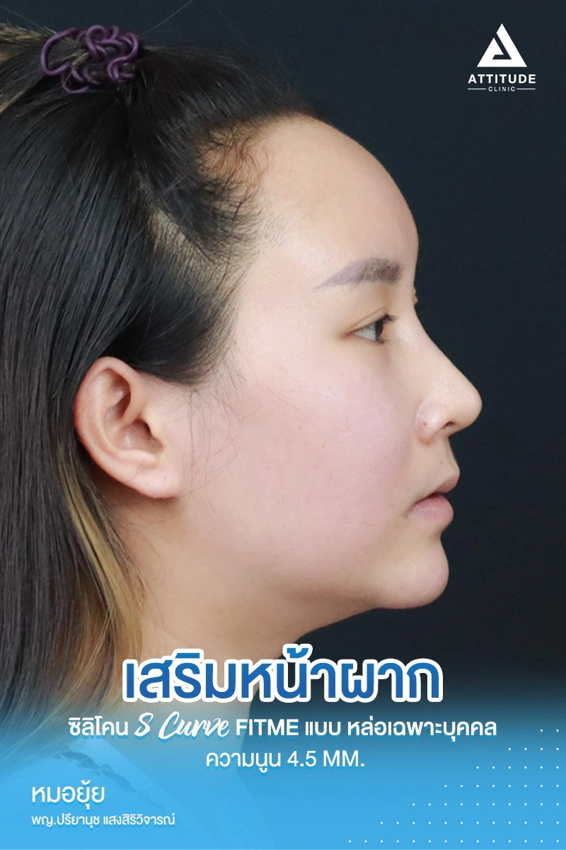 เสริมหน้าผาก