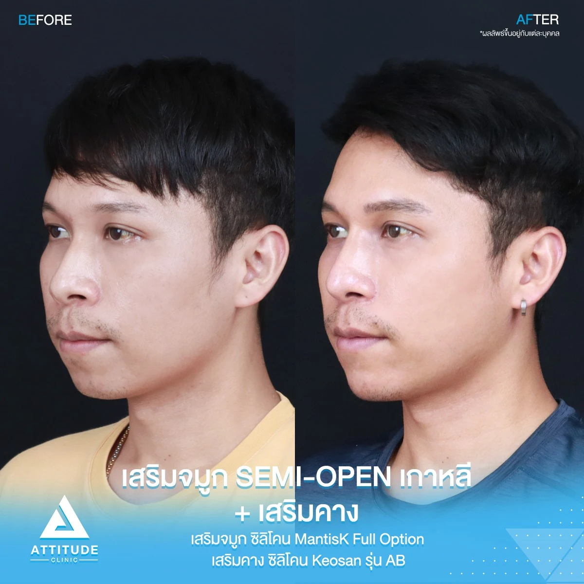 เสริมจมูก เสริมคาง