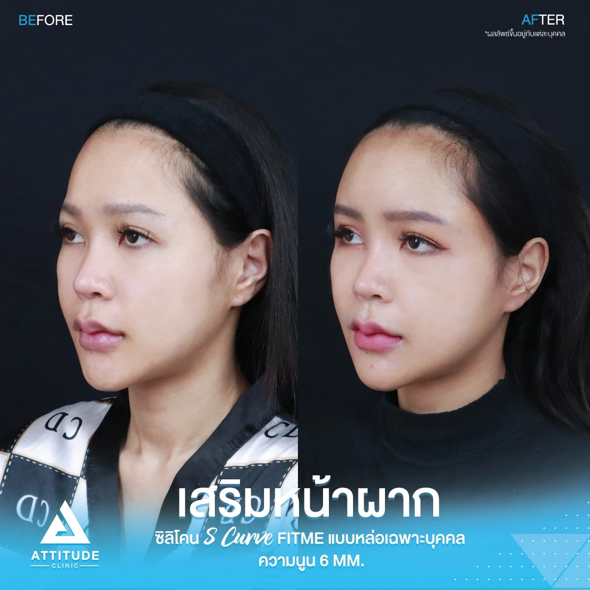 เสริมหน้าผาก