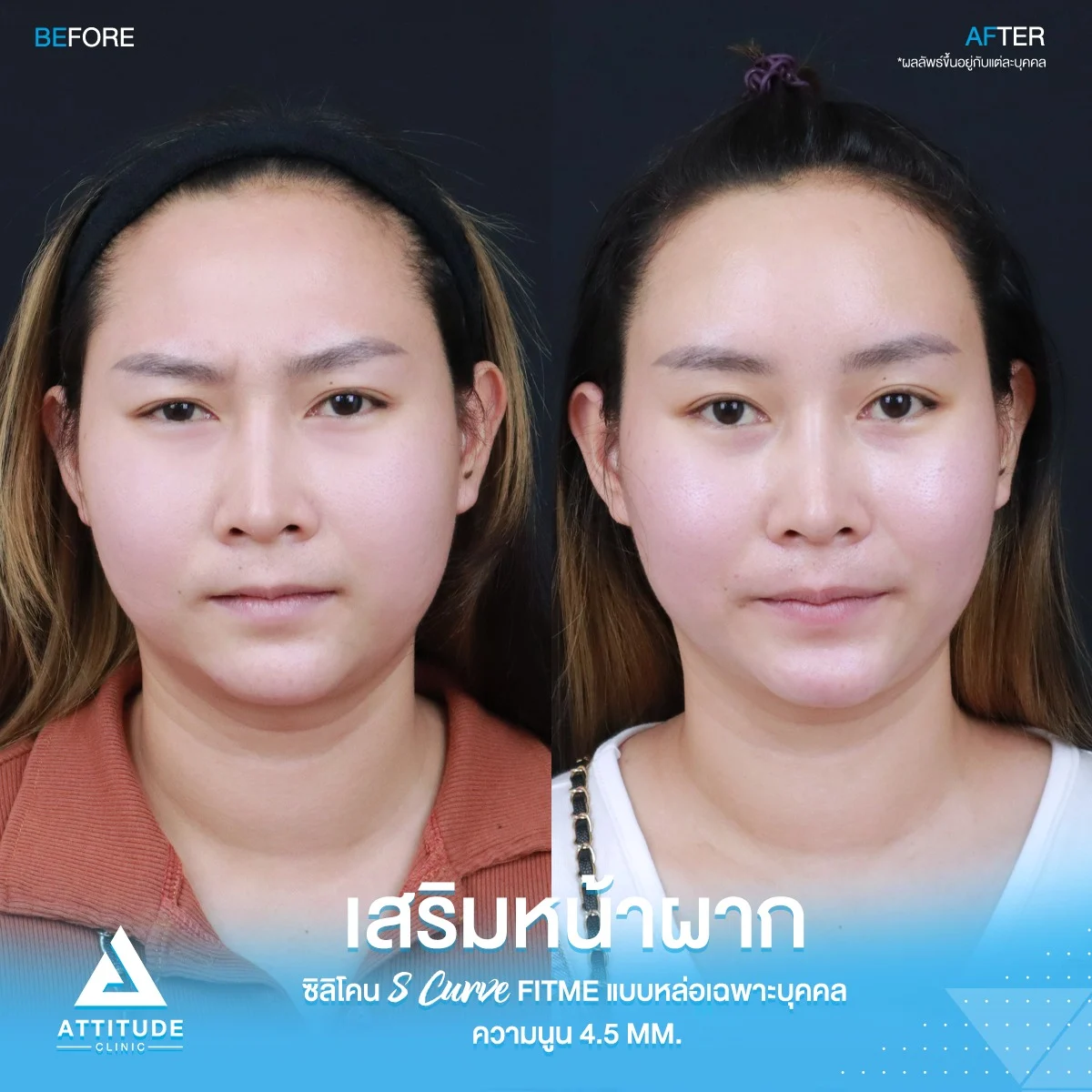 เสริมหน้าผาก
