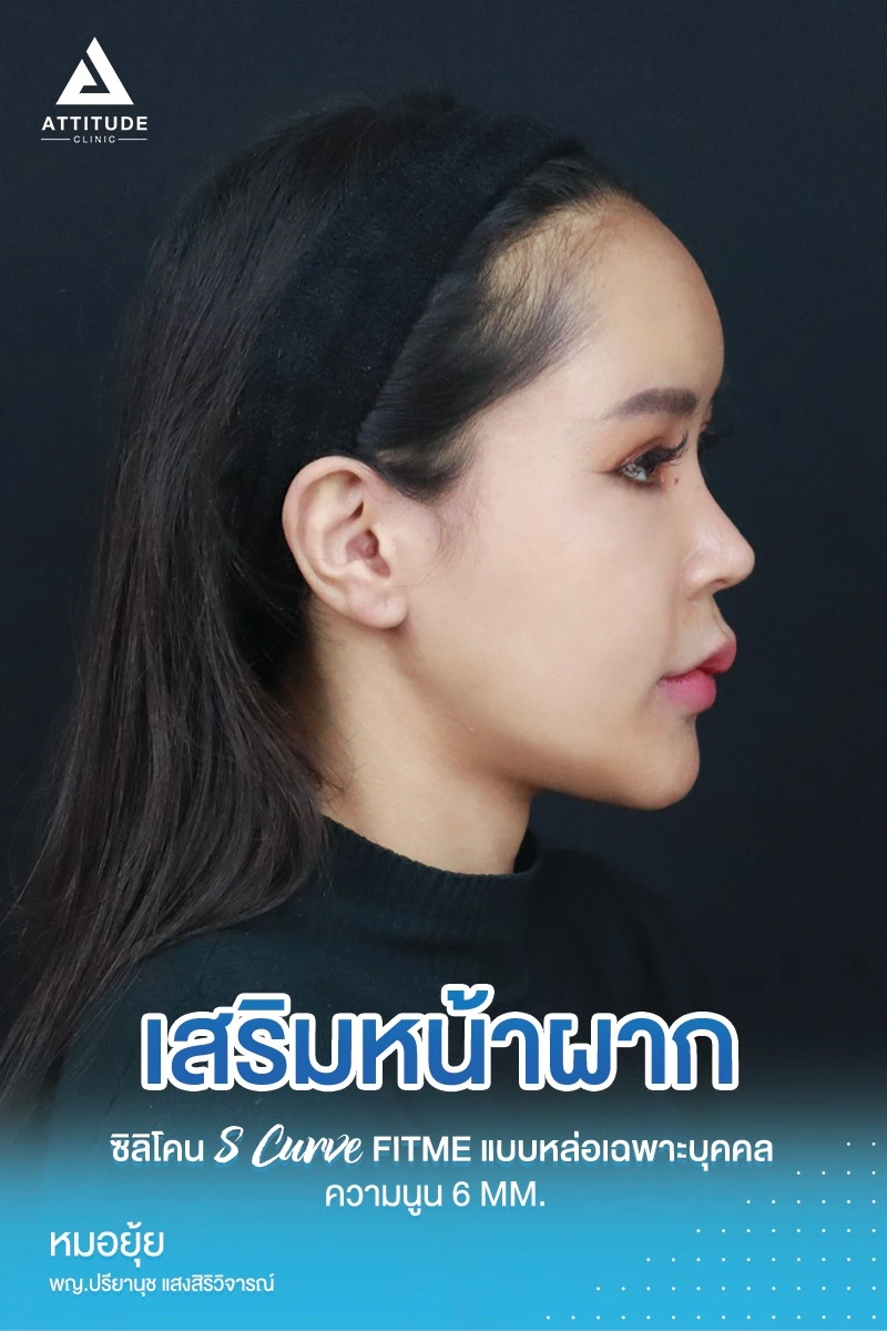 เสริมหน้าผาก