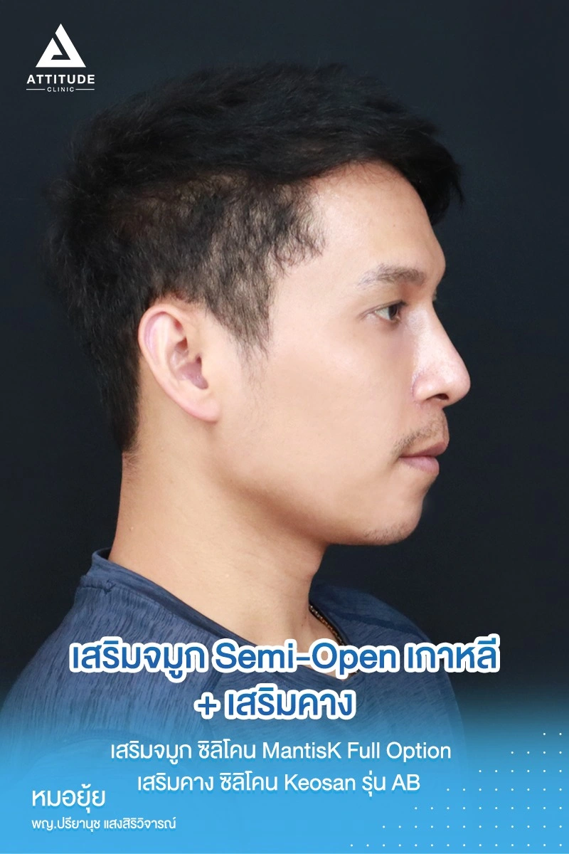 เสริมจมูก เสริมคาง