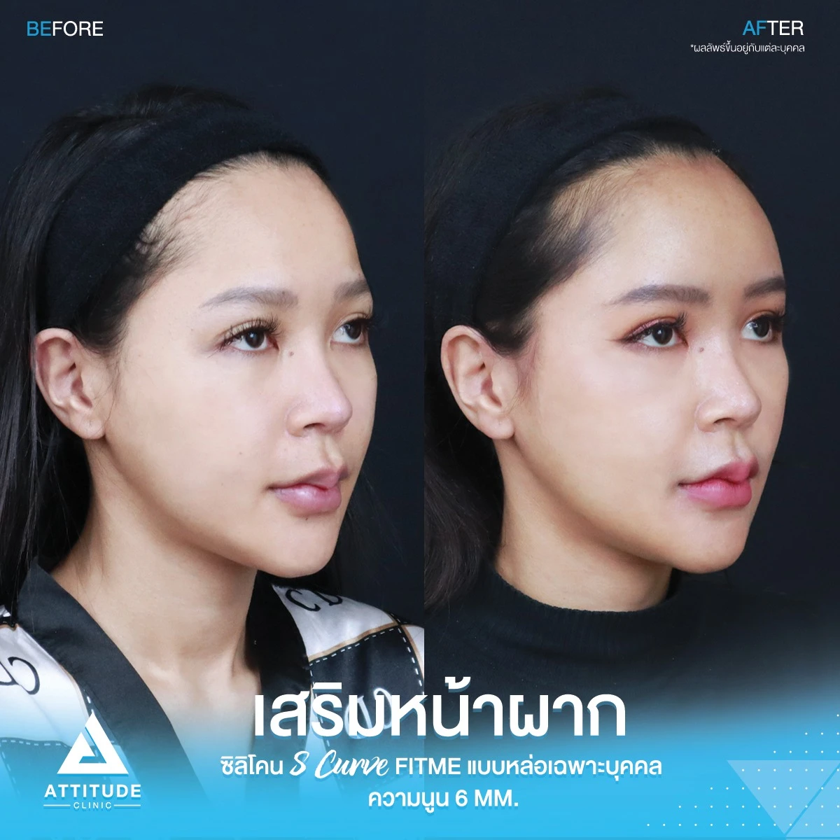 เสริมหน้าผาก