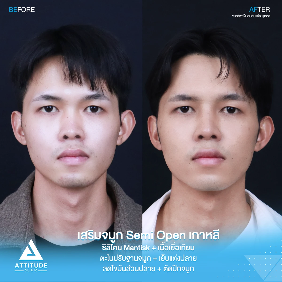 เสริมจมูก