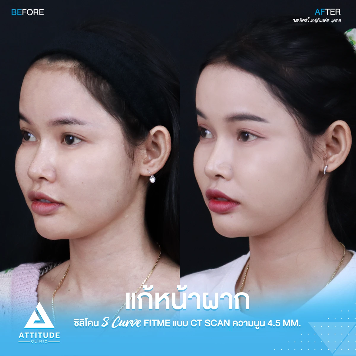 เสริมหน้าผาก
