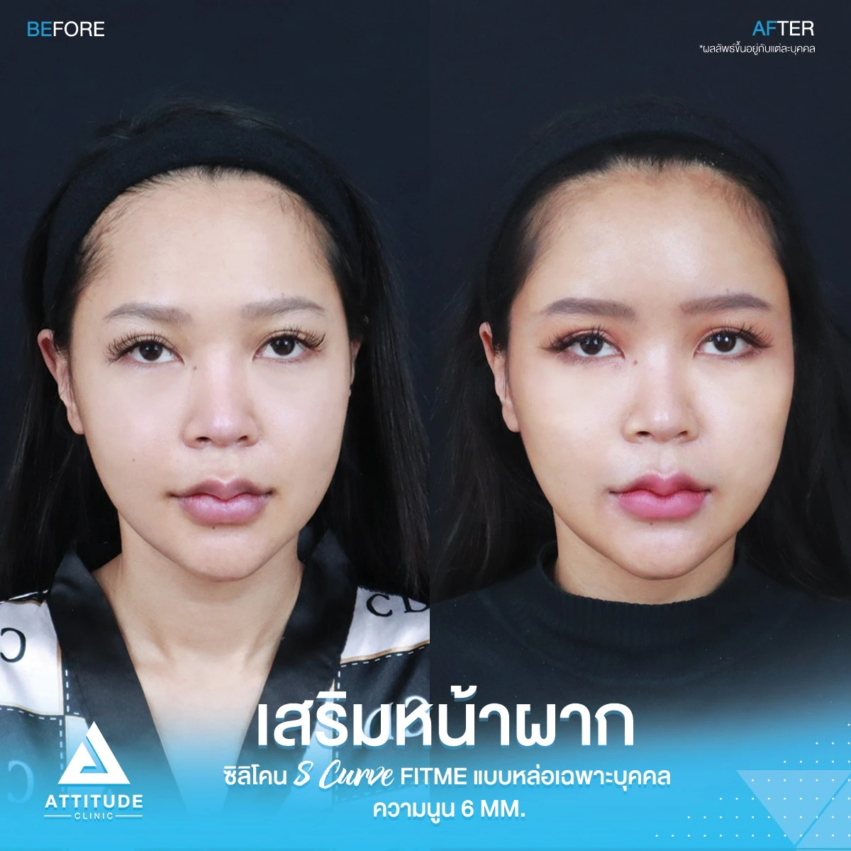 เสริมหน้าผาก