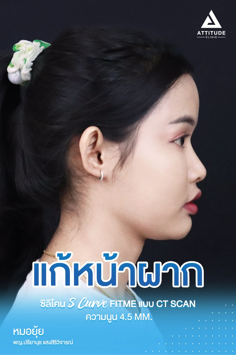 เสริมหน้าผาก