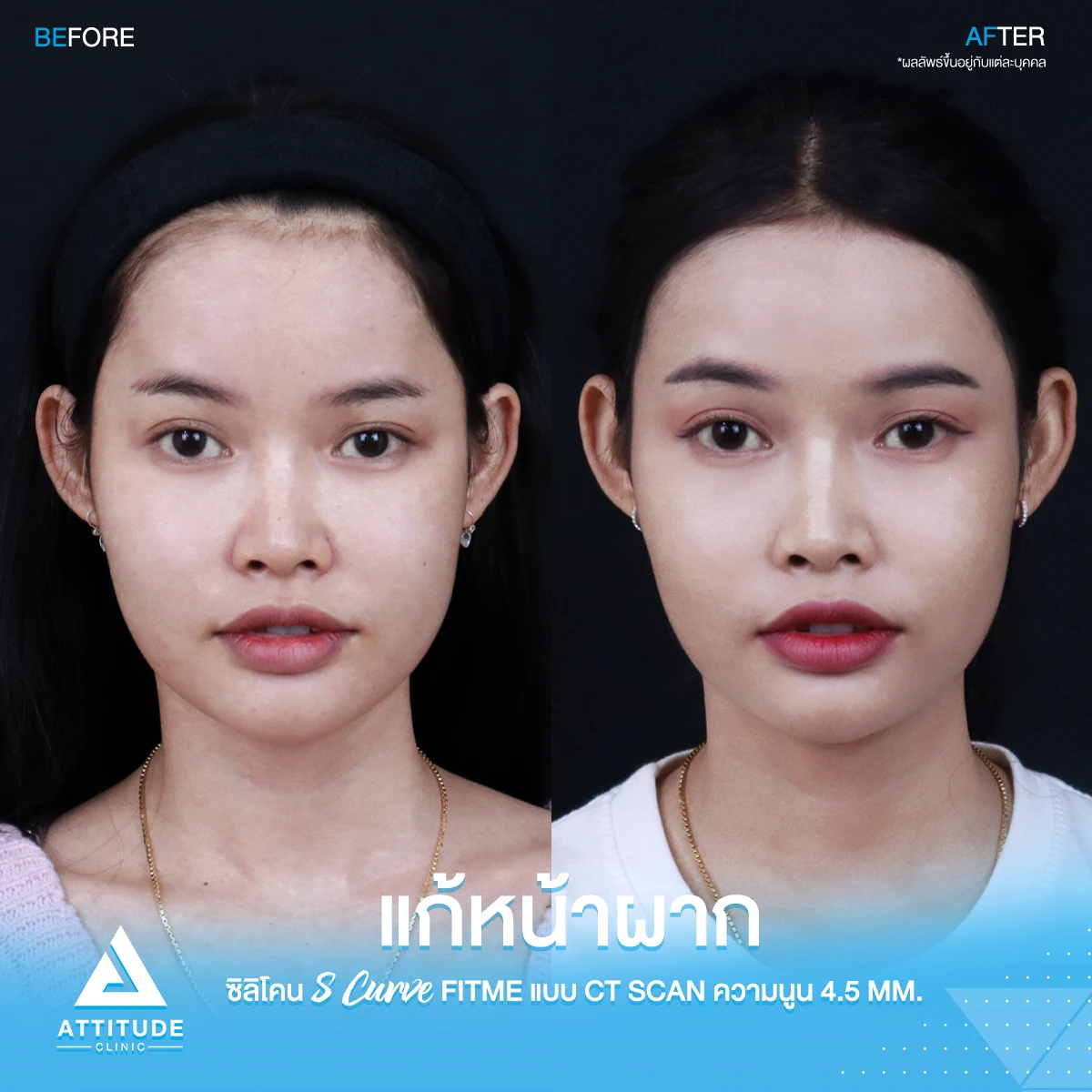 เสริมหน้าผาก