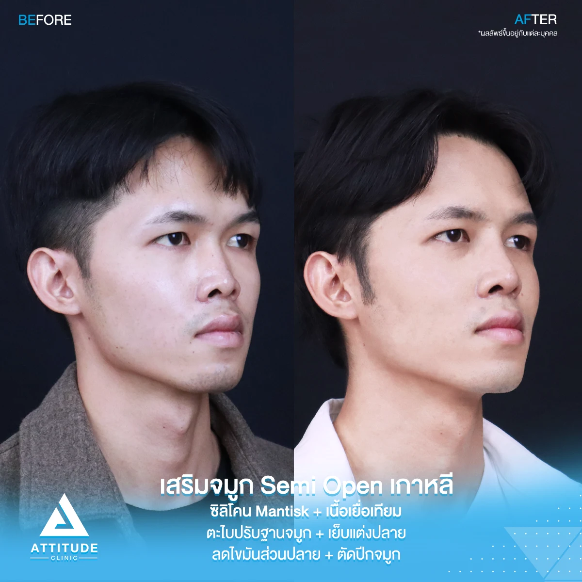 เสริมจมูก
