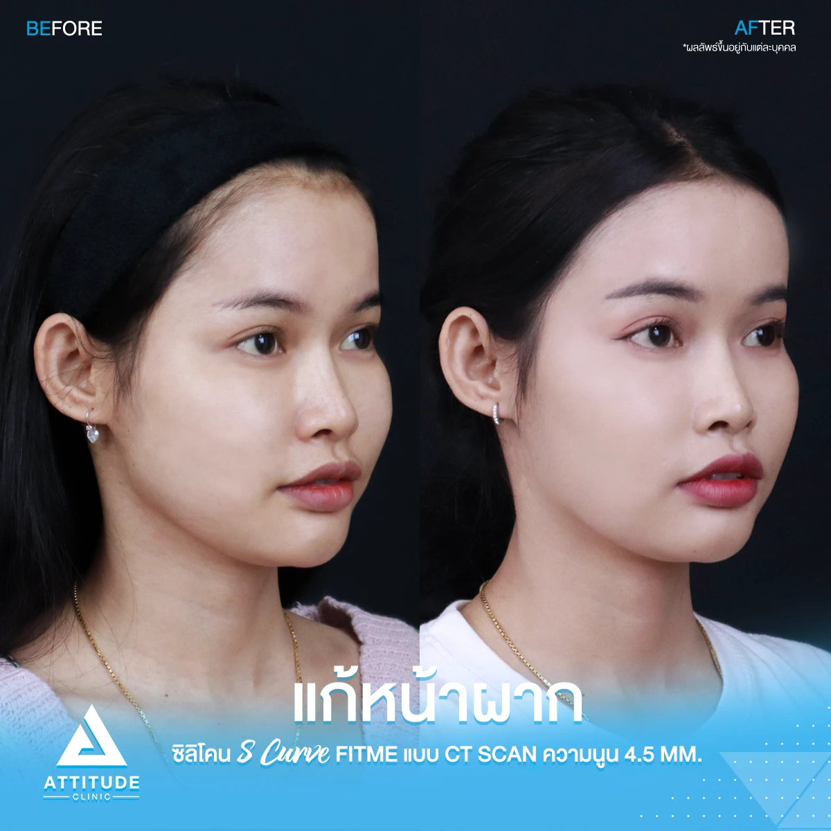 เสริมหน้าผาก