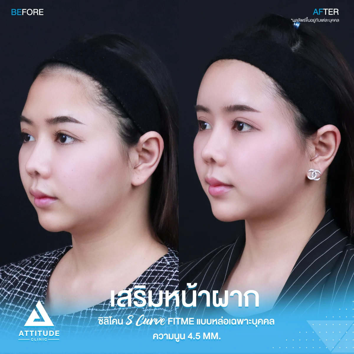 เสริมหน้าผาก
