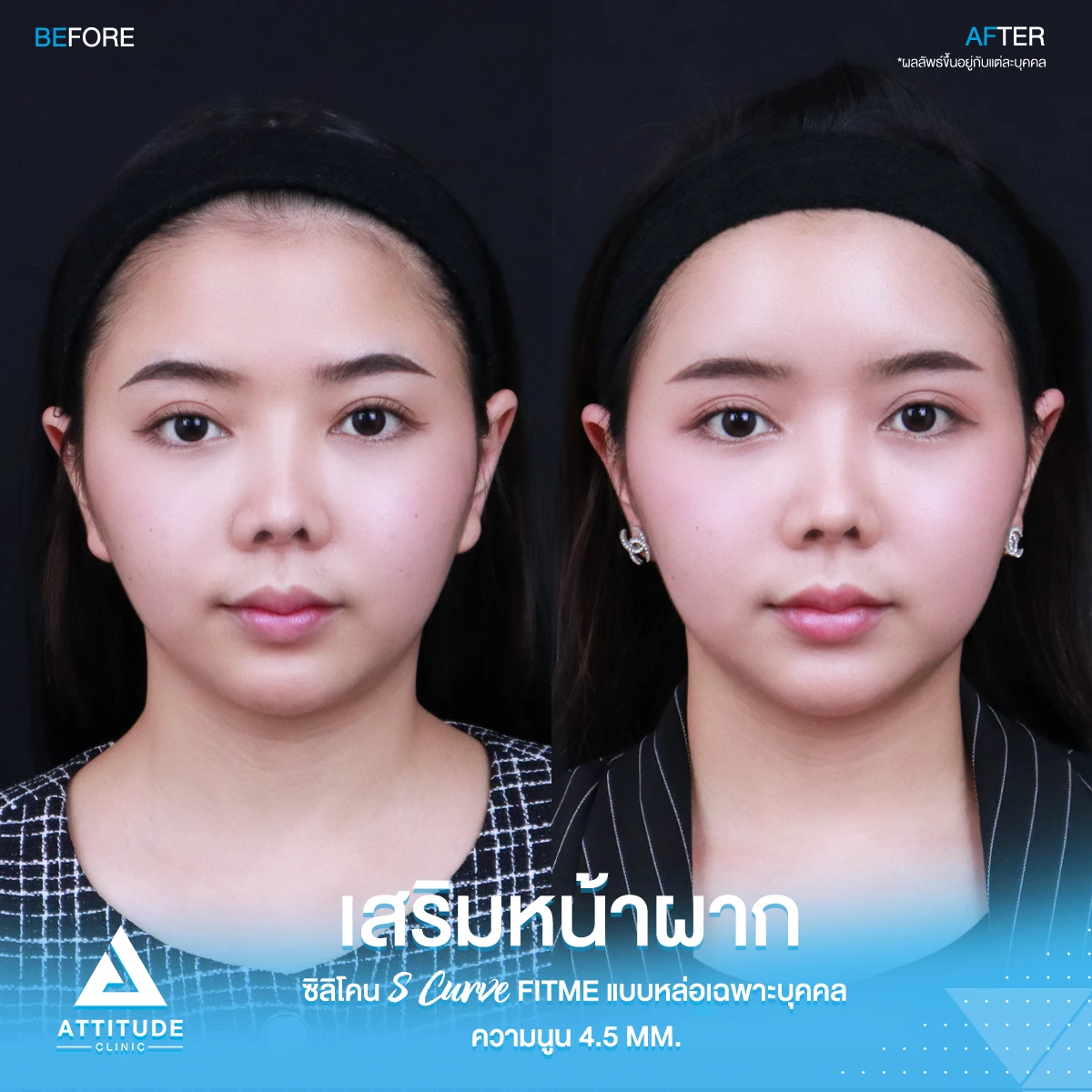 เสริมหน้าผาก