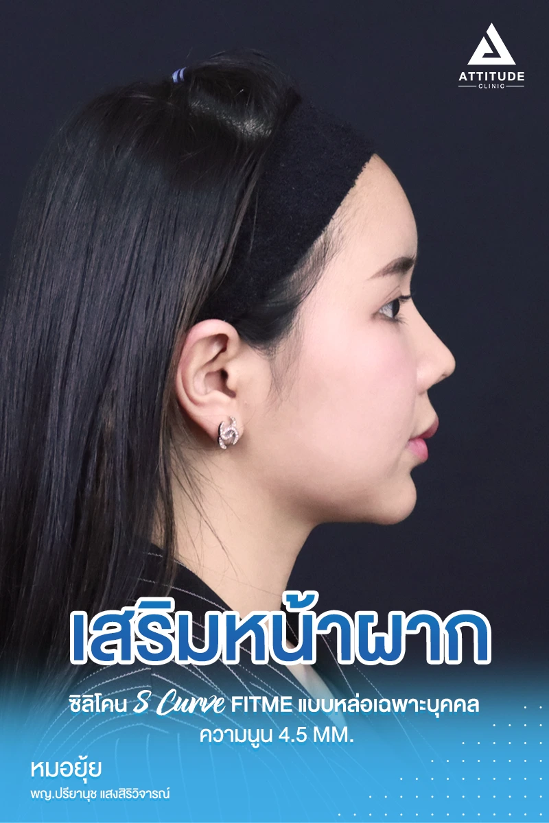 เสริมหน้าผาก