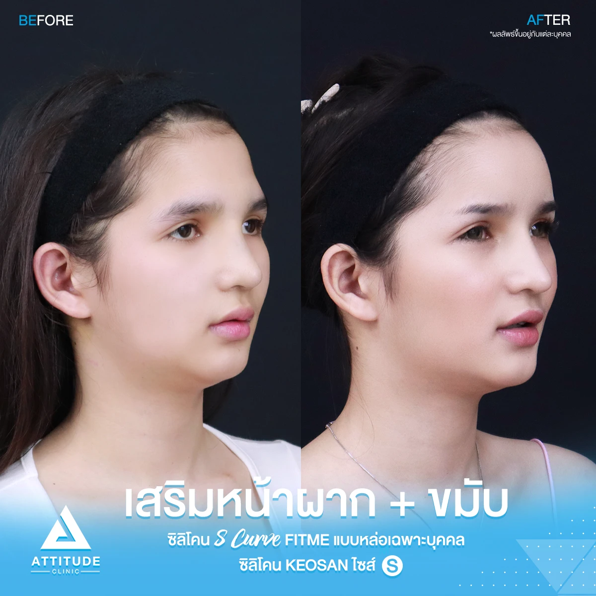 เสริมหน้าผาก