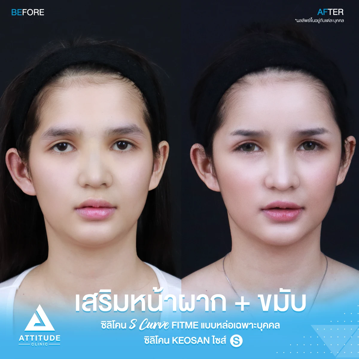 เสริมหน้าผาก
