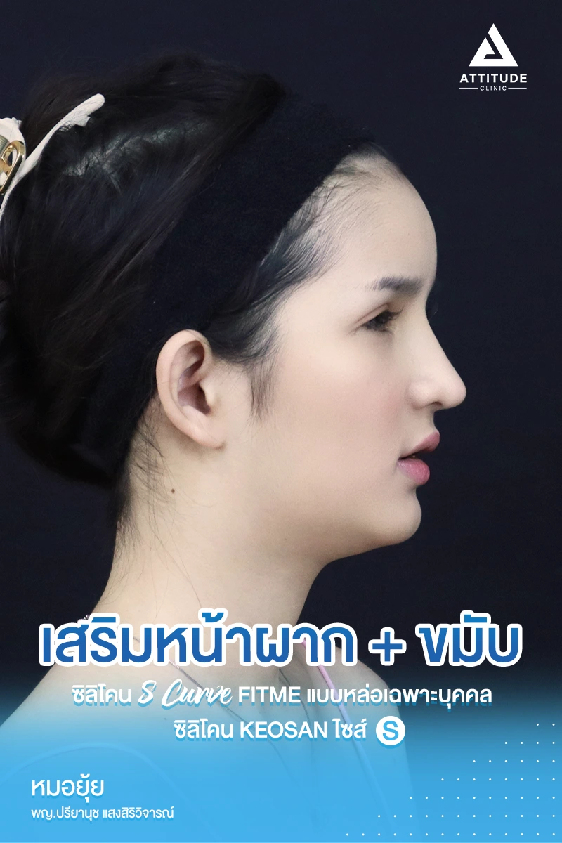 เสริมหน้าผาก