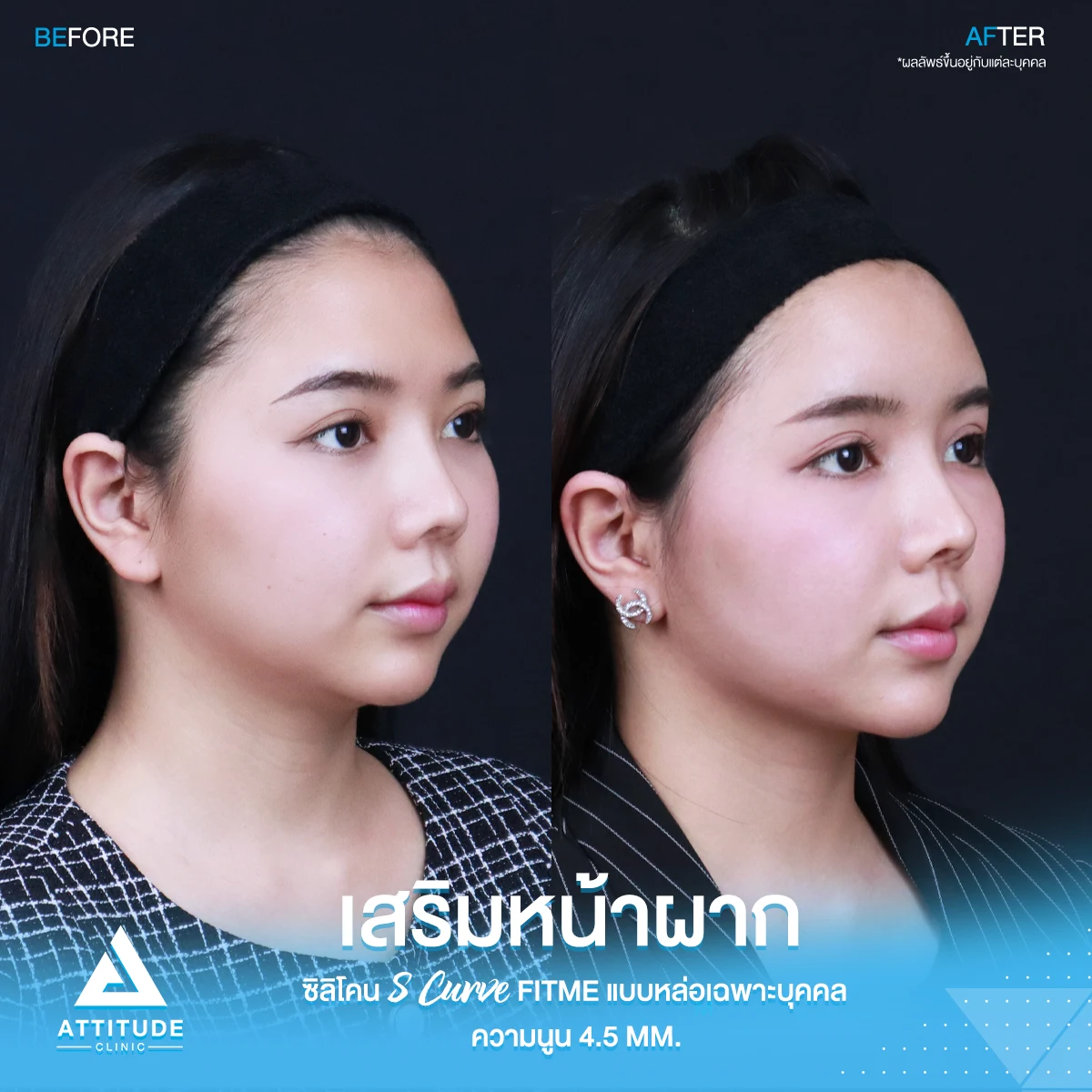 เสริมหน้าผาก