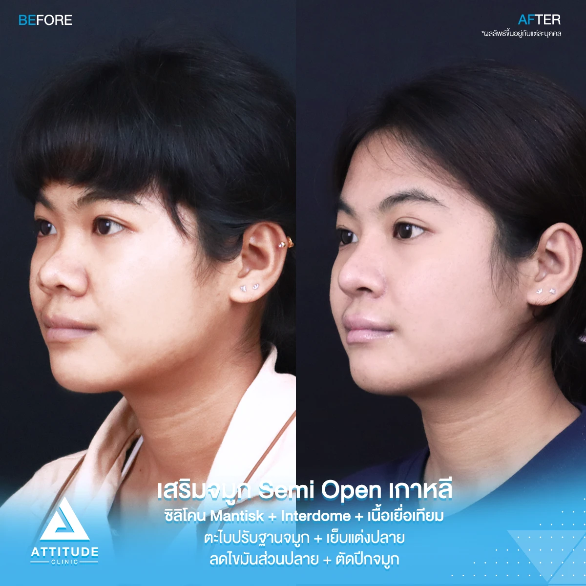 เสริมจมูก