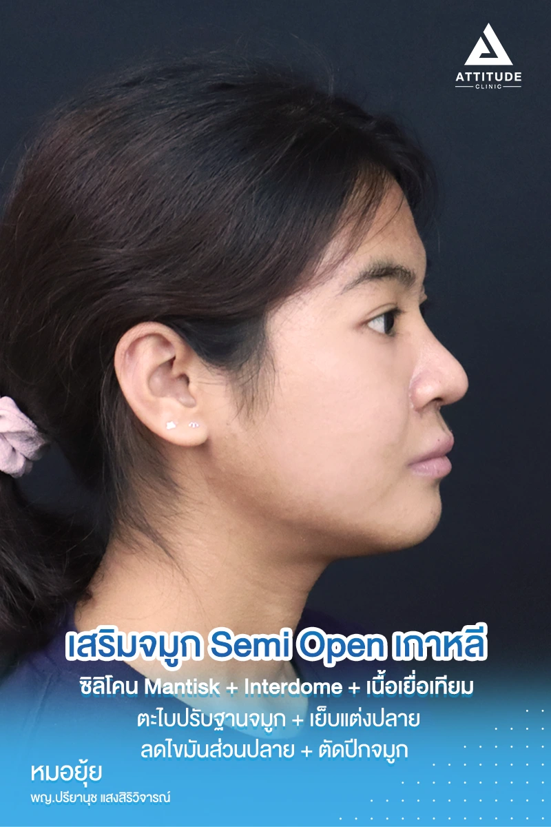 เสริมจมูก