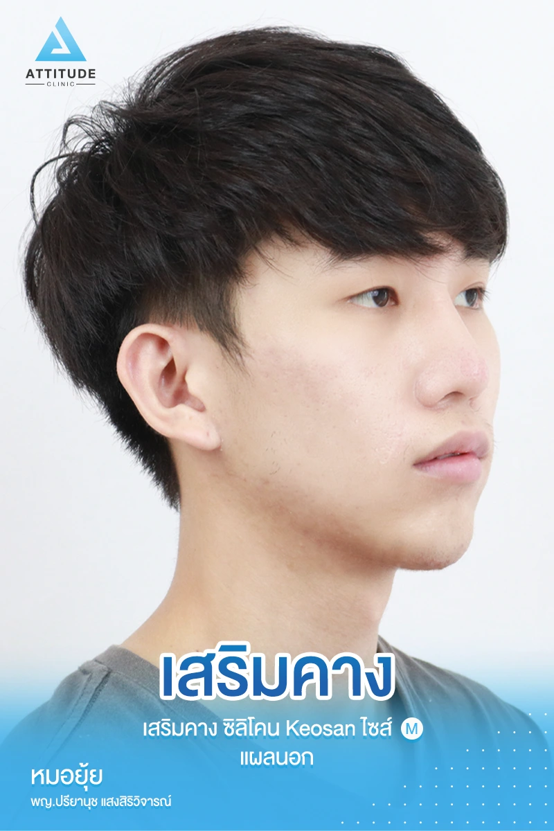 เสริมคาง