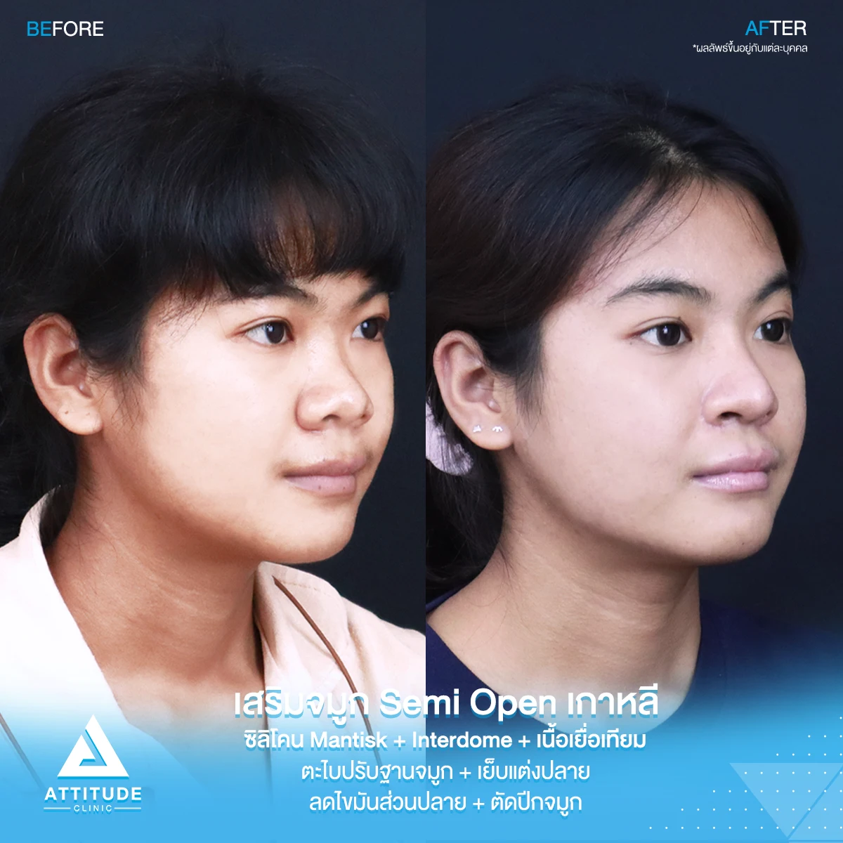 เสริมจมูก