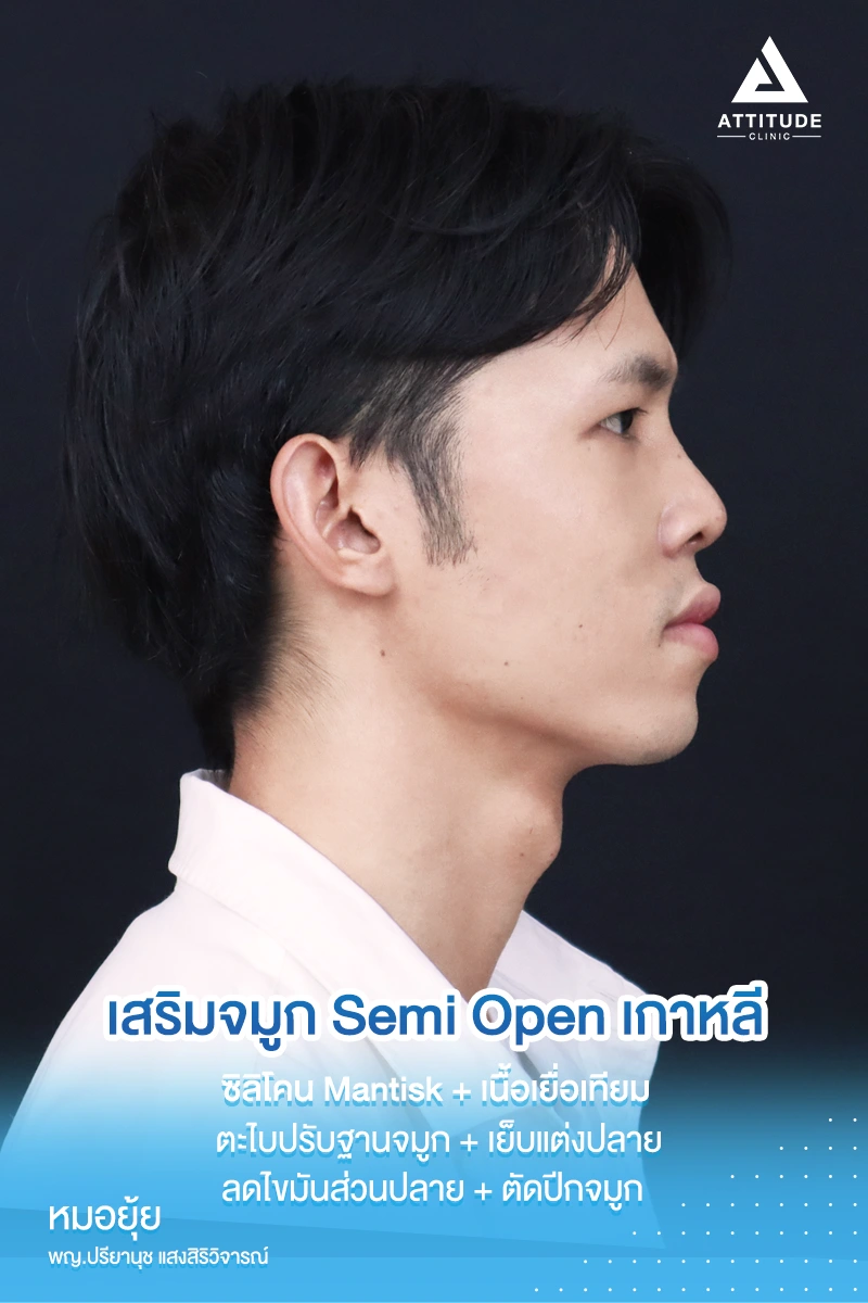 เสริมจมูก