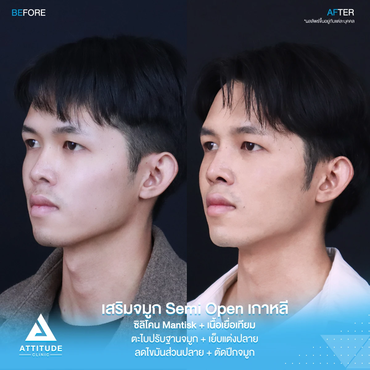 เสริมจมูก