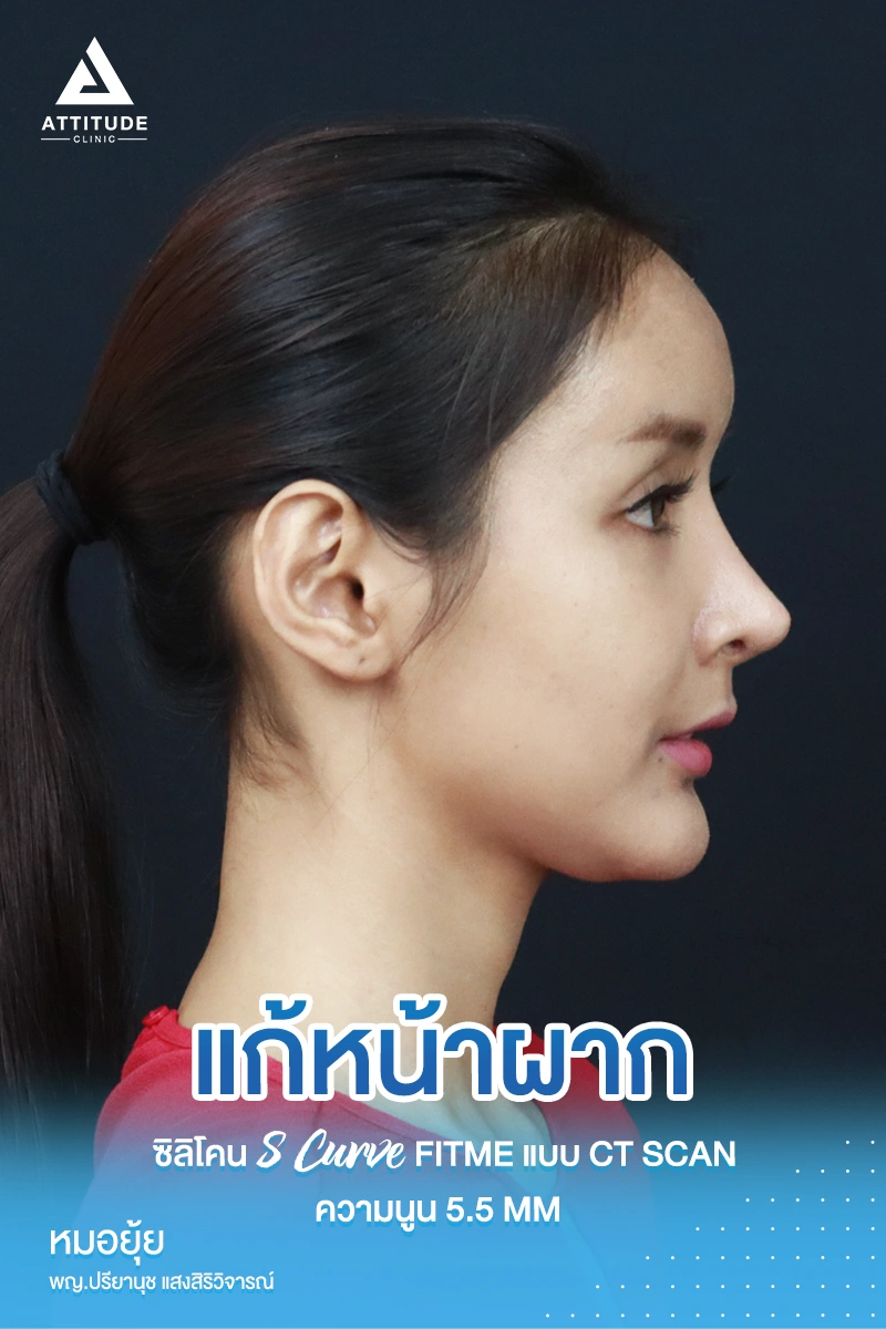 เสริมหน้าผาก