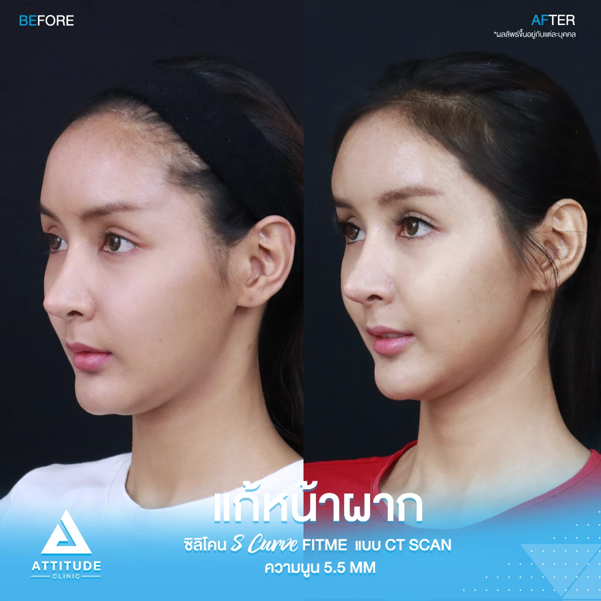 เสริมหน้าผาก