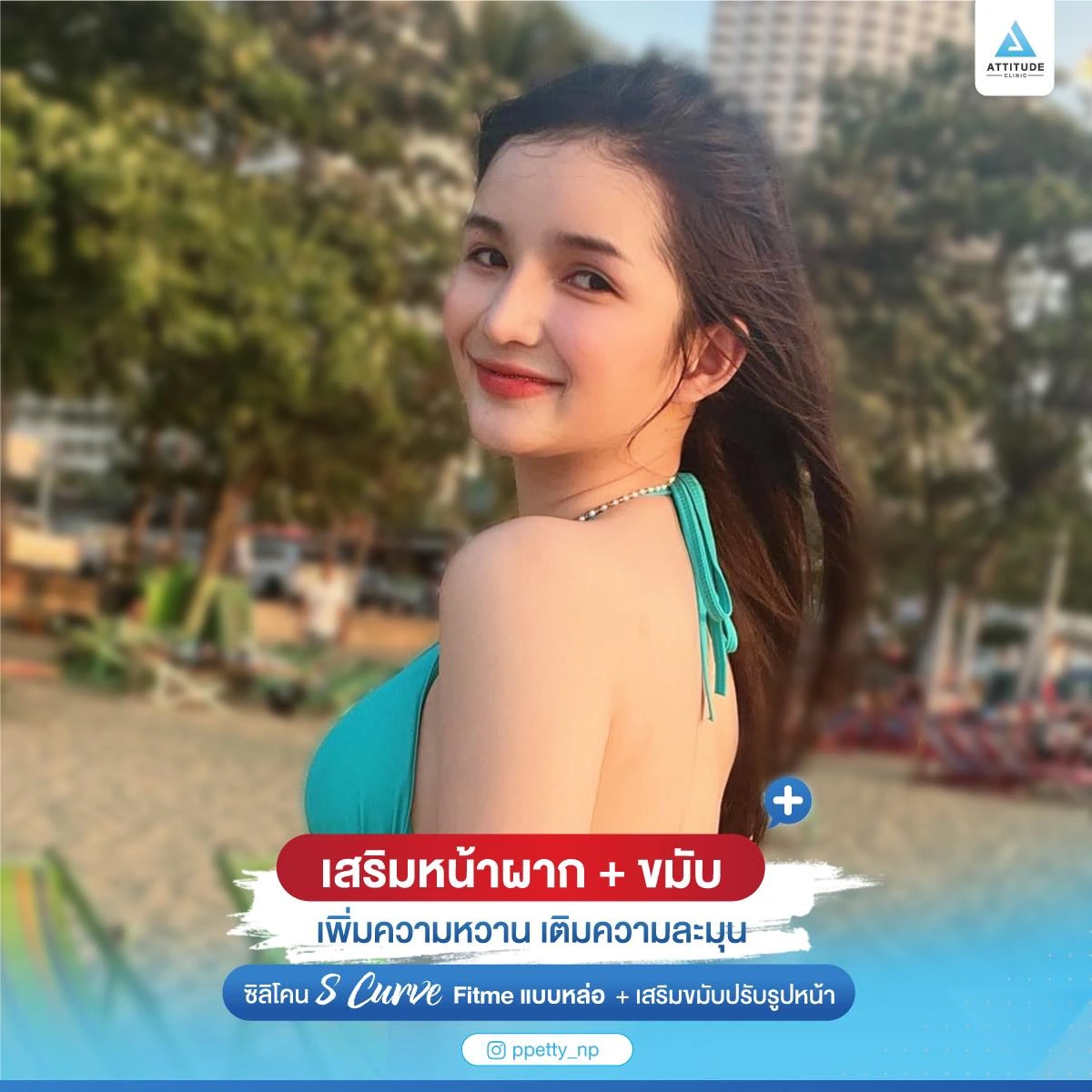 เสริมหน้าผาก เสริมขมับ