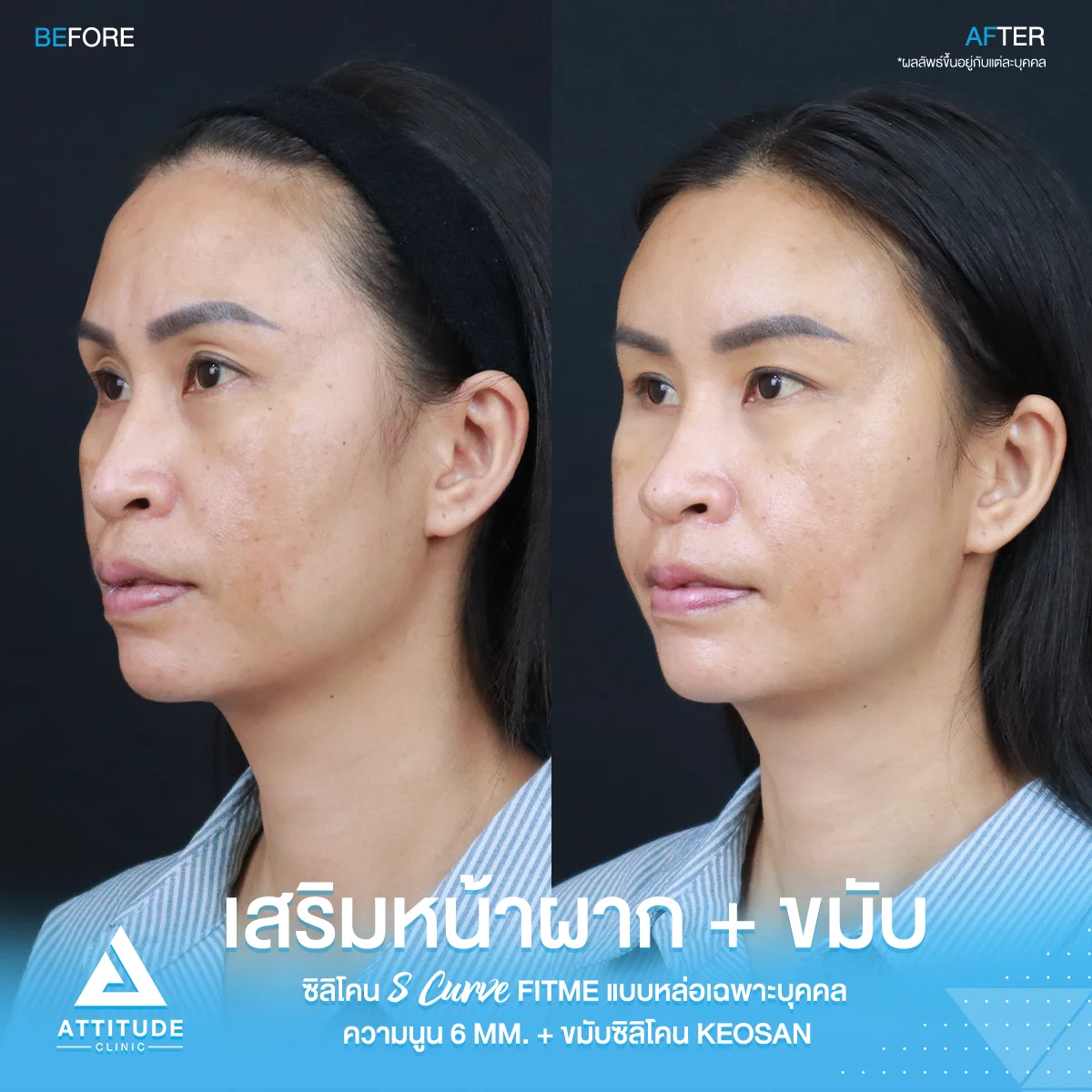 เสริมหน้าผาก เสริมขมับ