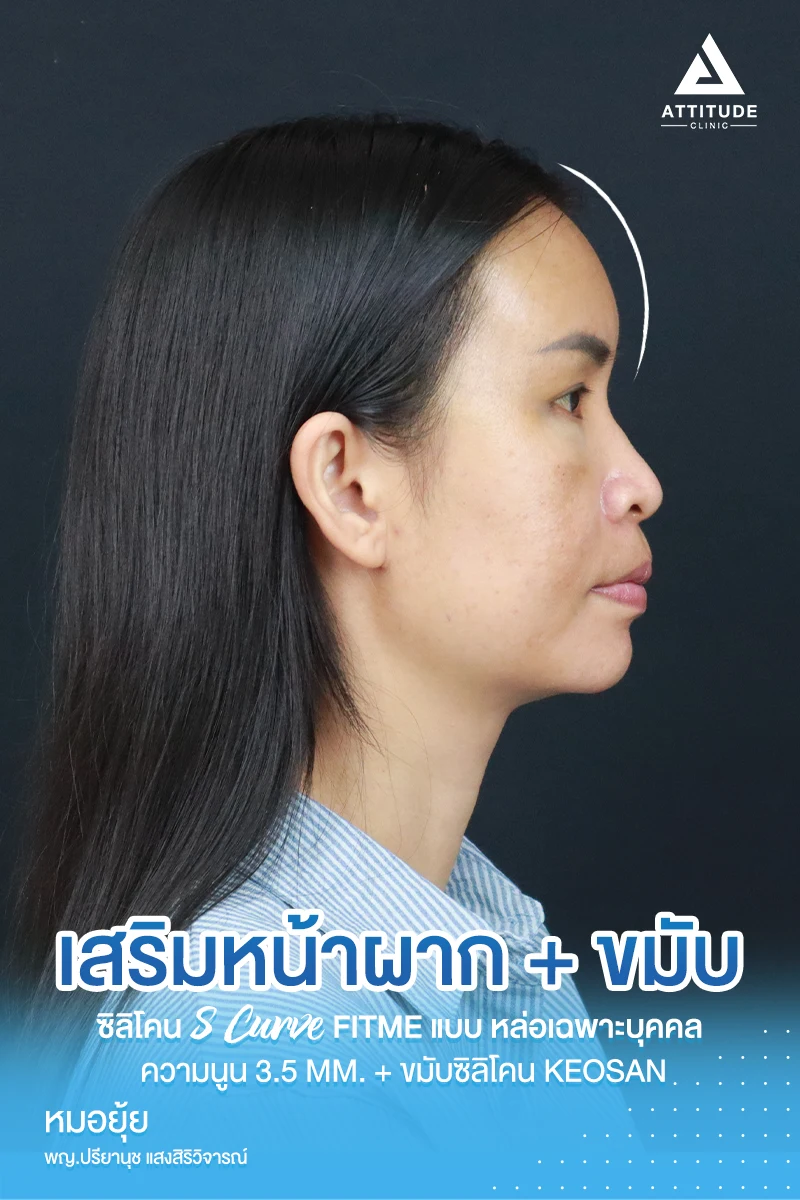 เสริมหน้าผาก เสริมขมับ