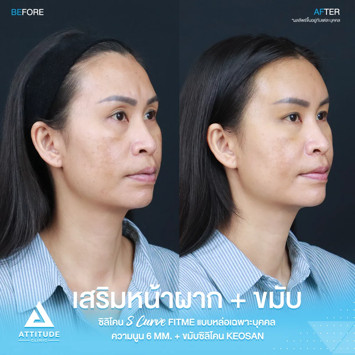 เสริมหน้าผาก เสริมขมับ