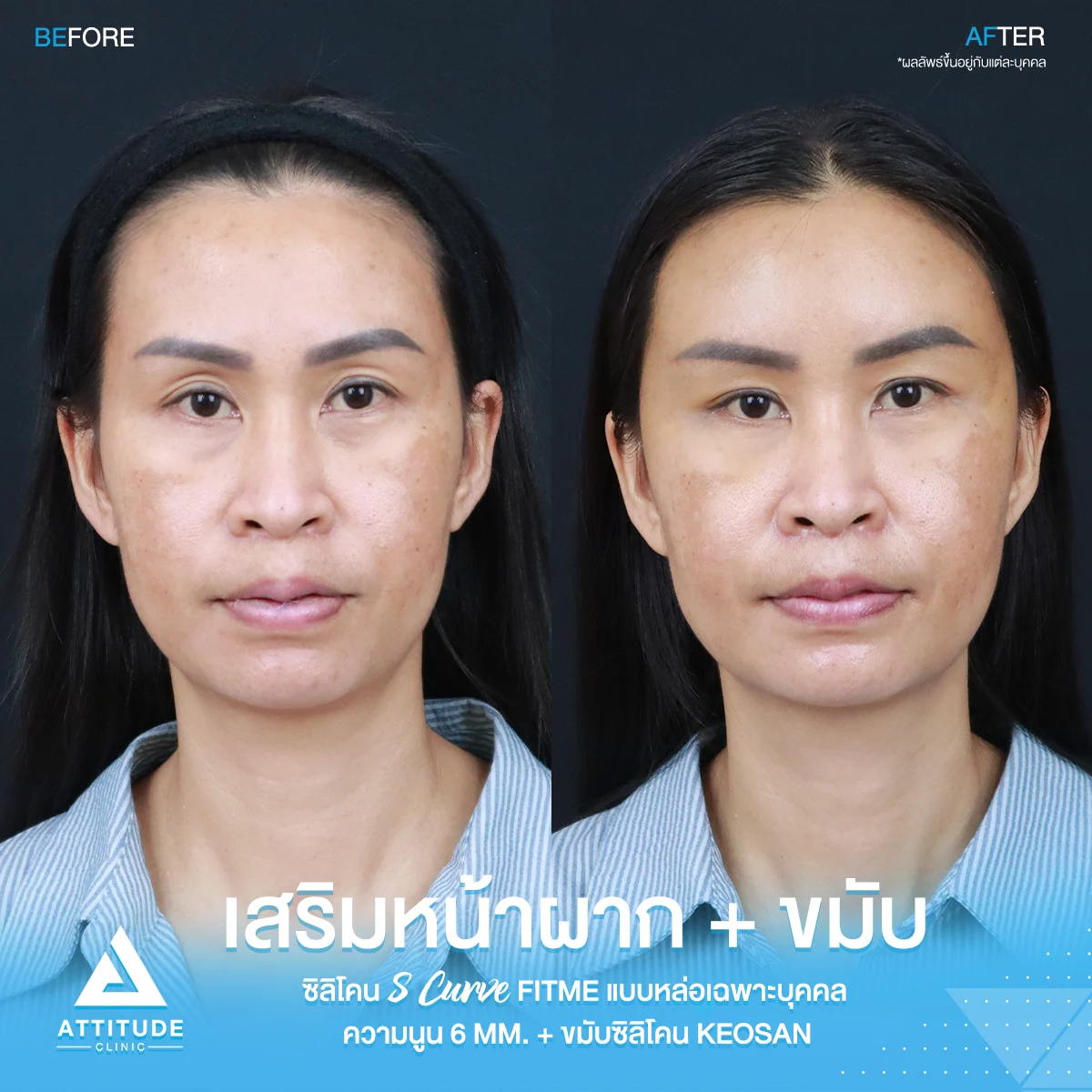 เสริมหน้าผาก เสริมขมับ
