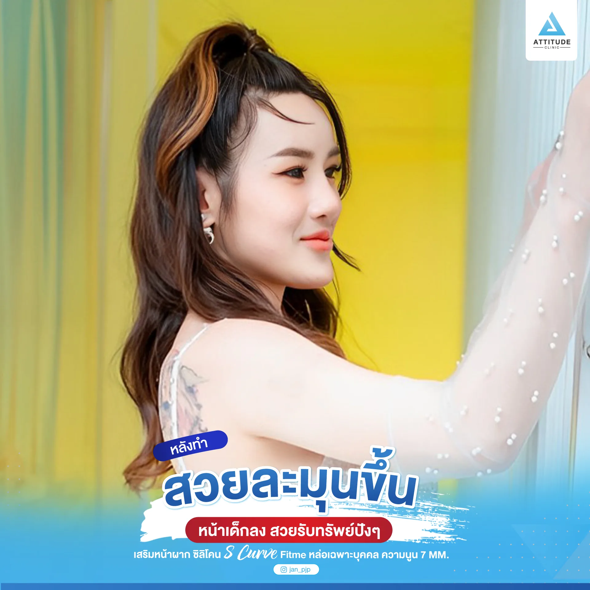 เสริมหน้าผาก
