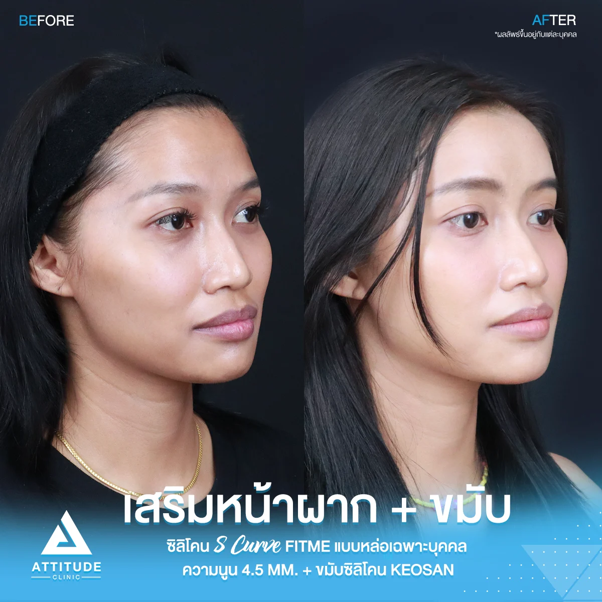 เสริมหน้าผาก