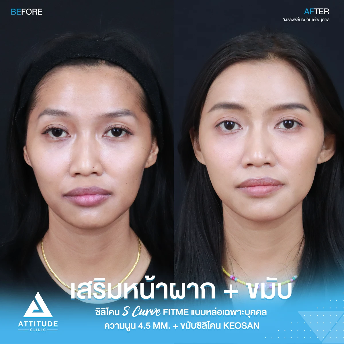 เสริมหน้าผาก