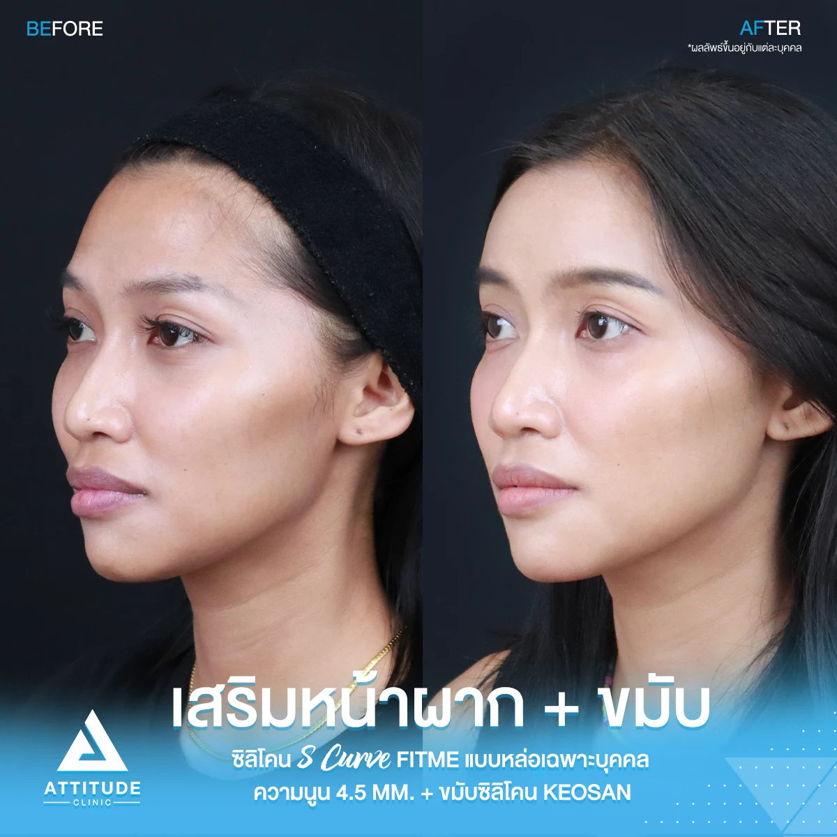 เสริมหน้าผาก