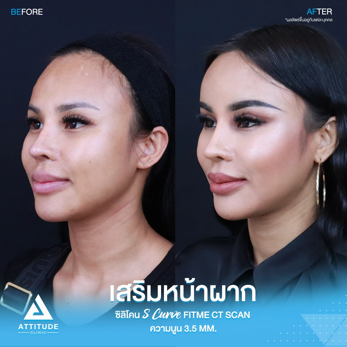เสริมหน้าผาก