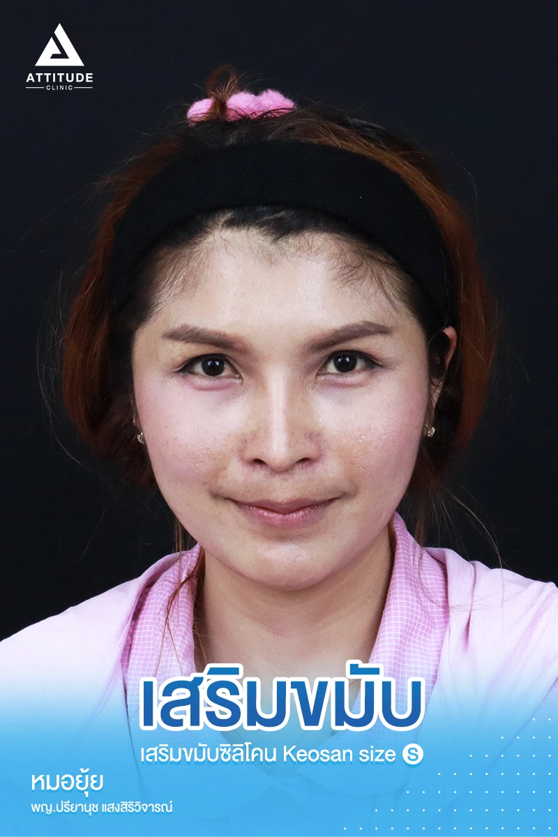 เสริมขมับ
