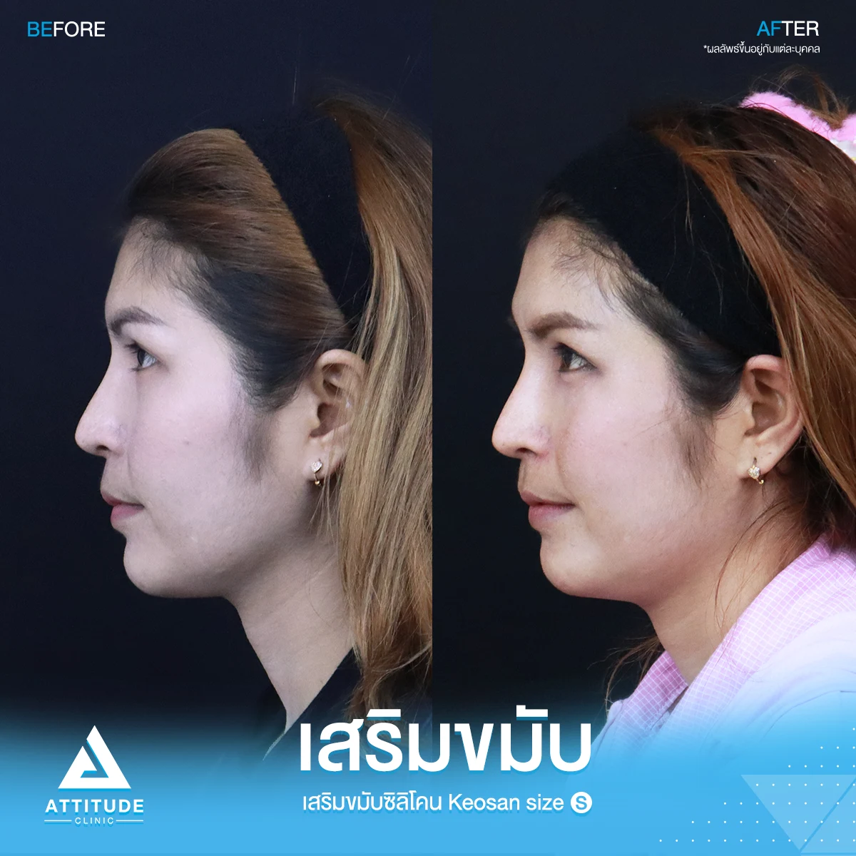 เสริมขมับ